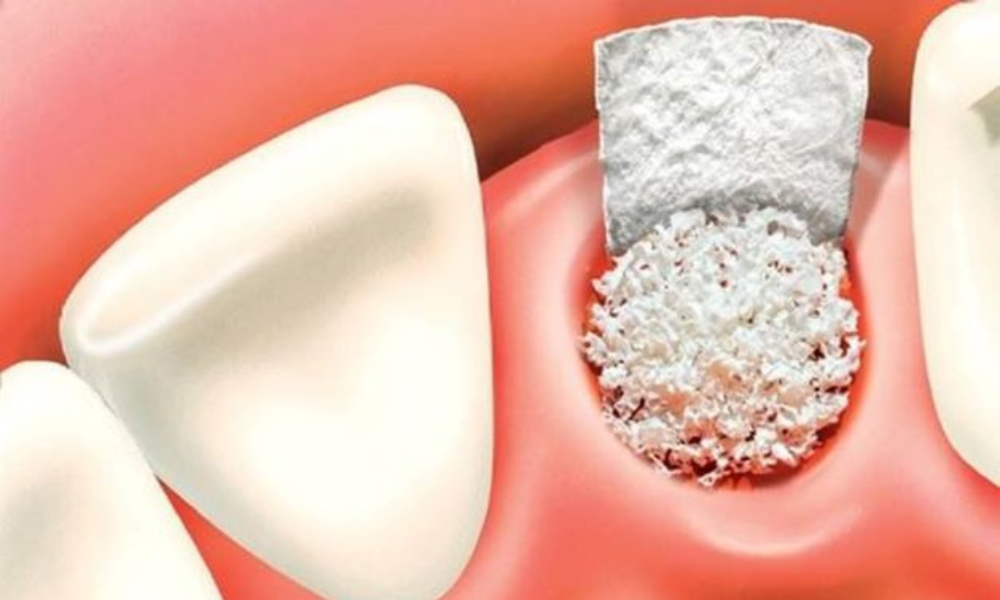 ghép xương cấy implant có đau không