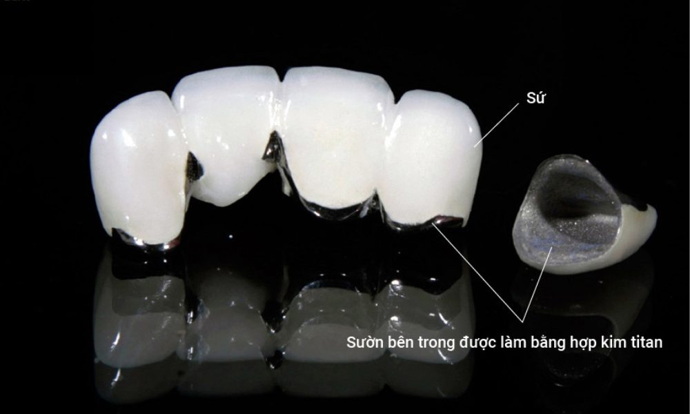 so sánh răng sứ kim loại và răng toàn sứ