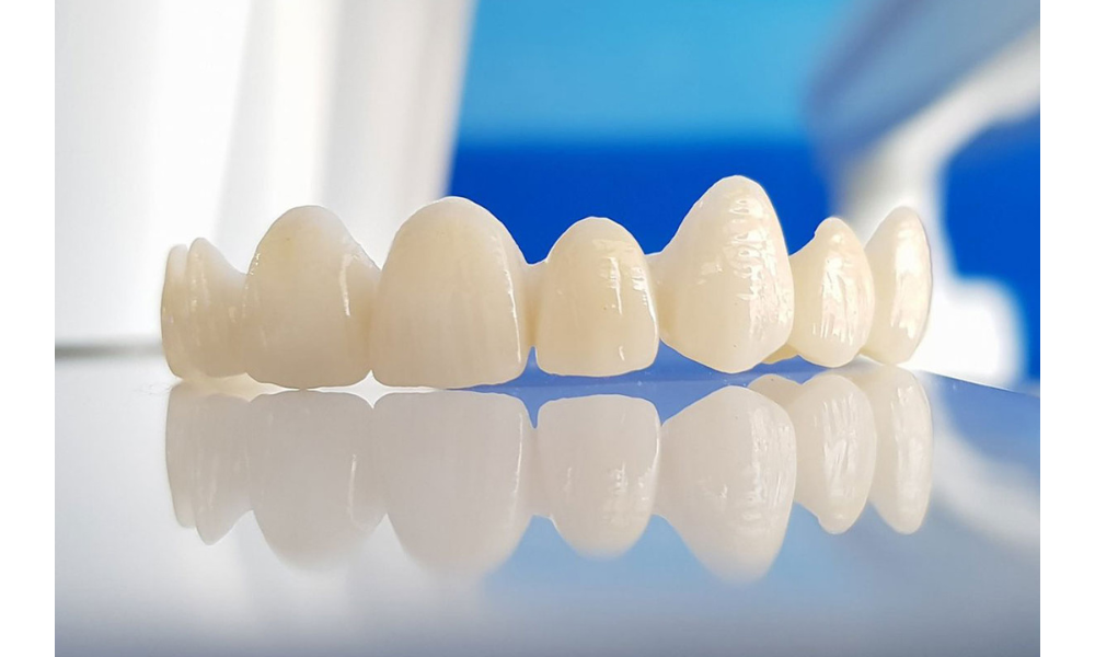 so sánh răng sứ kim loại và răng toàn sứ