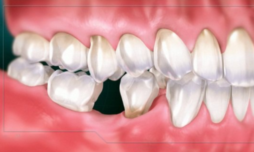 biến chứng sau cấy implant