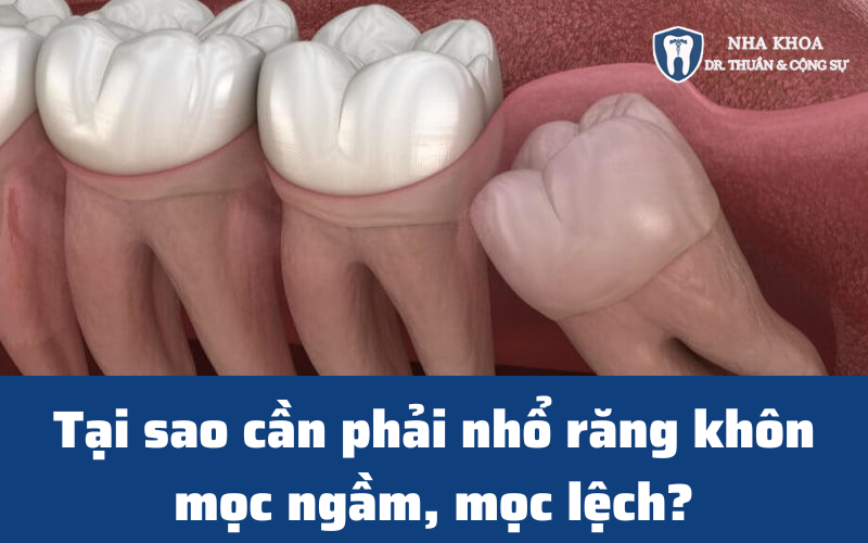 nho rang khon moc ngam thumb