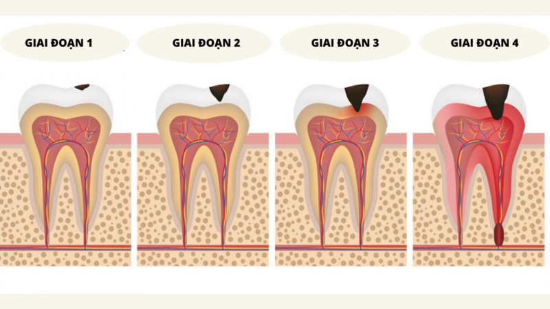 viem-tuy-xuong-ham-2