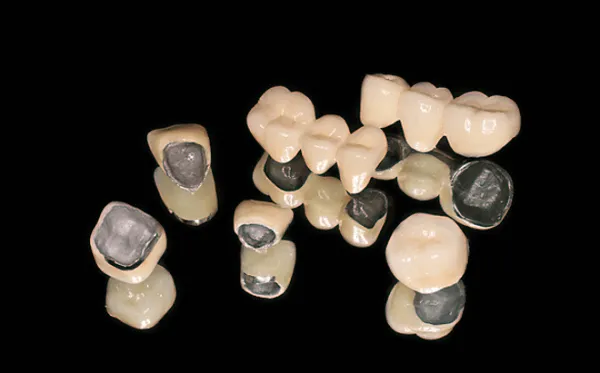 Tuổi thọ của răng sứ kim loại kéo dài khoảng 3 - 5 năm