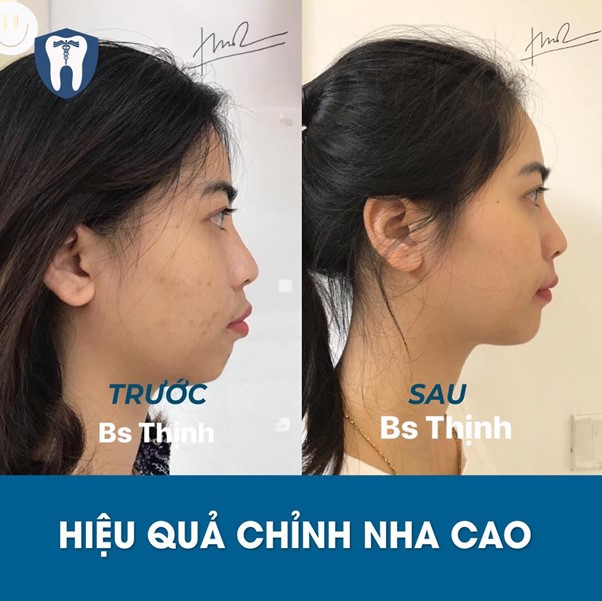 kinh nghiệm niềng răng