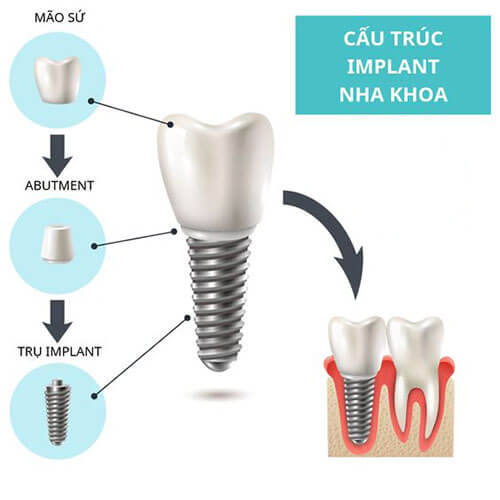 cau tao rang implant