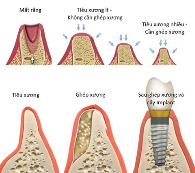 ghep xuong trong cay ghep implant 02