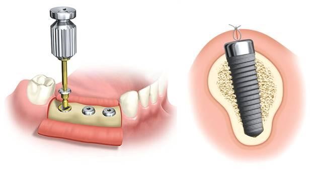 vis de coverture suba dental implantation dentaire
