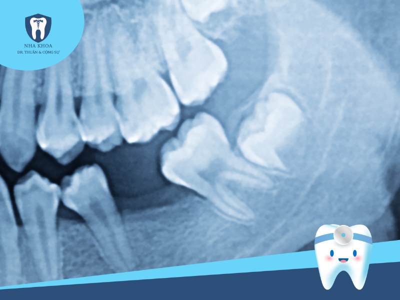 Chụp X-quang xác định vùng răng cần cấy tủy
