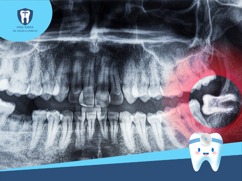 Chụp X-quang xác định vị trí răng khôn
