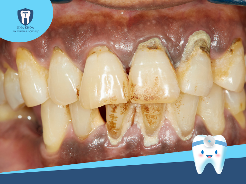 Hình ảnh hàm răng bị viêm nha chu