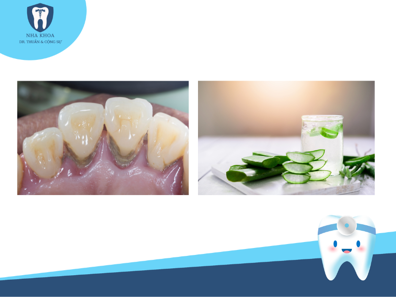 Lô hội giúp cải thiện tình trạng răng khi bị viêm nha chu