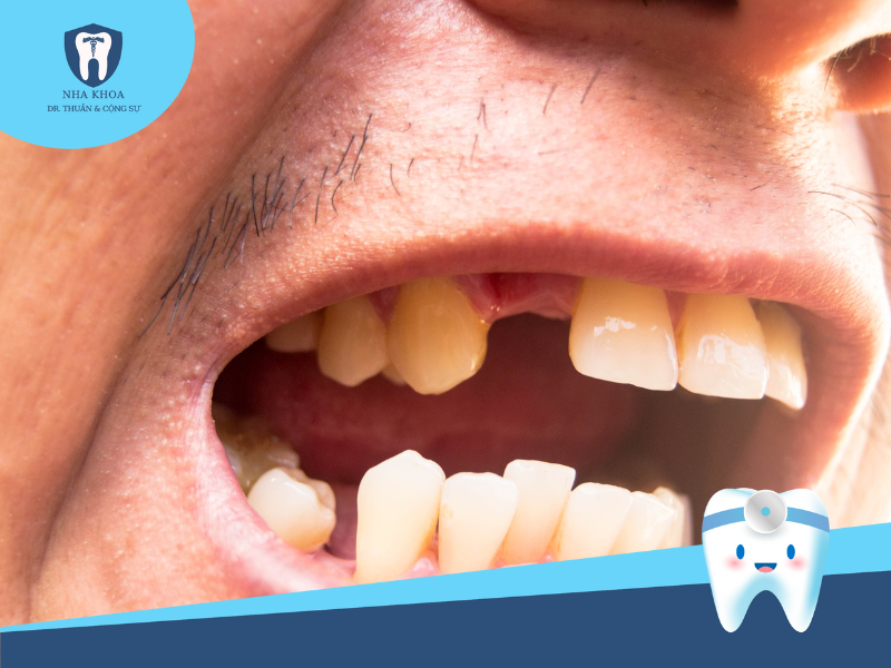Nên bọc răng sứ khi mất răng để bảo vệ hàm răng