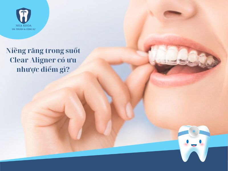 Niềng răng trong suốt Clear Aligner