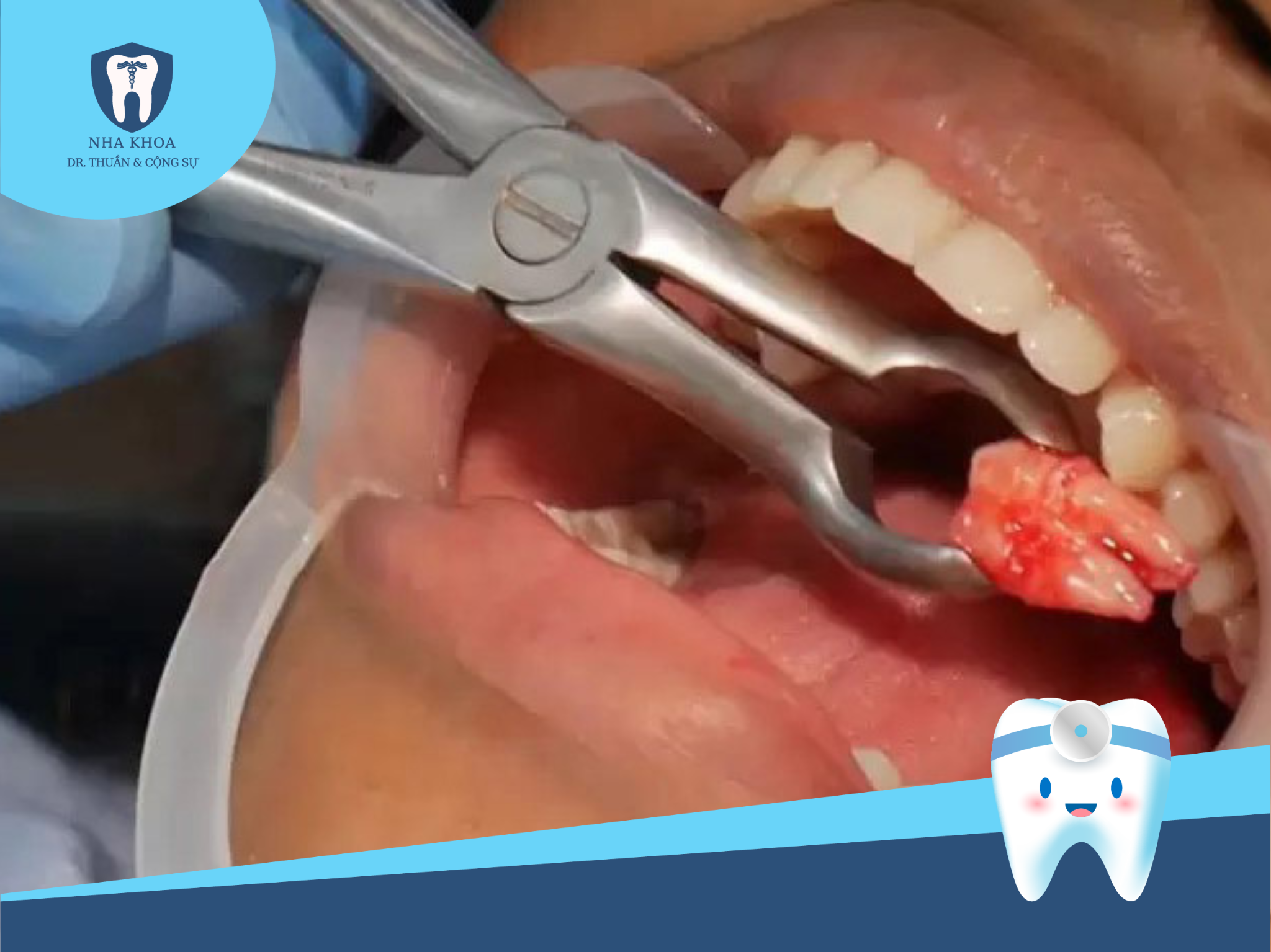 Nhiễm trùng viêm huyệt ổ răng khô và viêm huyệt răng có mủ là một trong những biến chứng sau khi nhổ răng số 8.