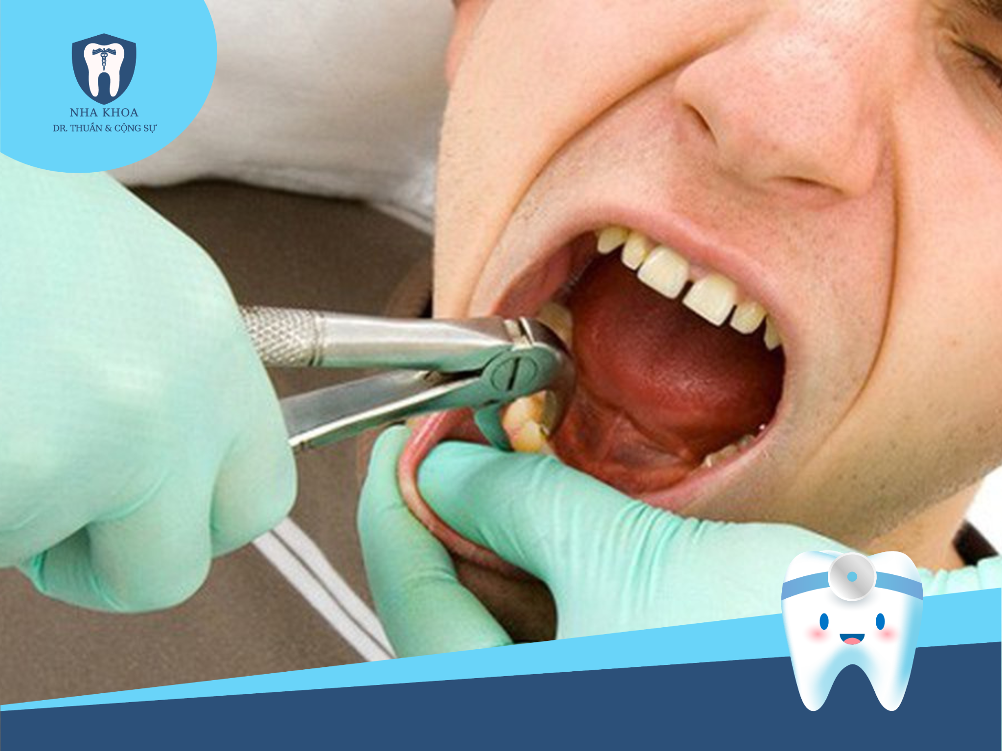 Những lưu ý này sẽ giúp giảm nguy cơ biến chứng và giữ cho quá trình phục hồi sau khi nhổ răng khôn diễn ra thuận lợi.