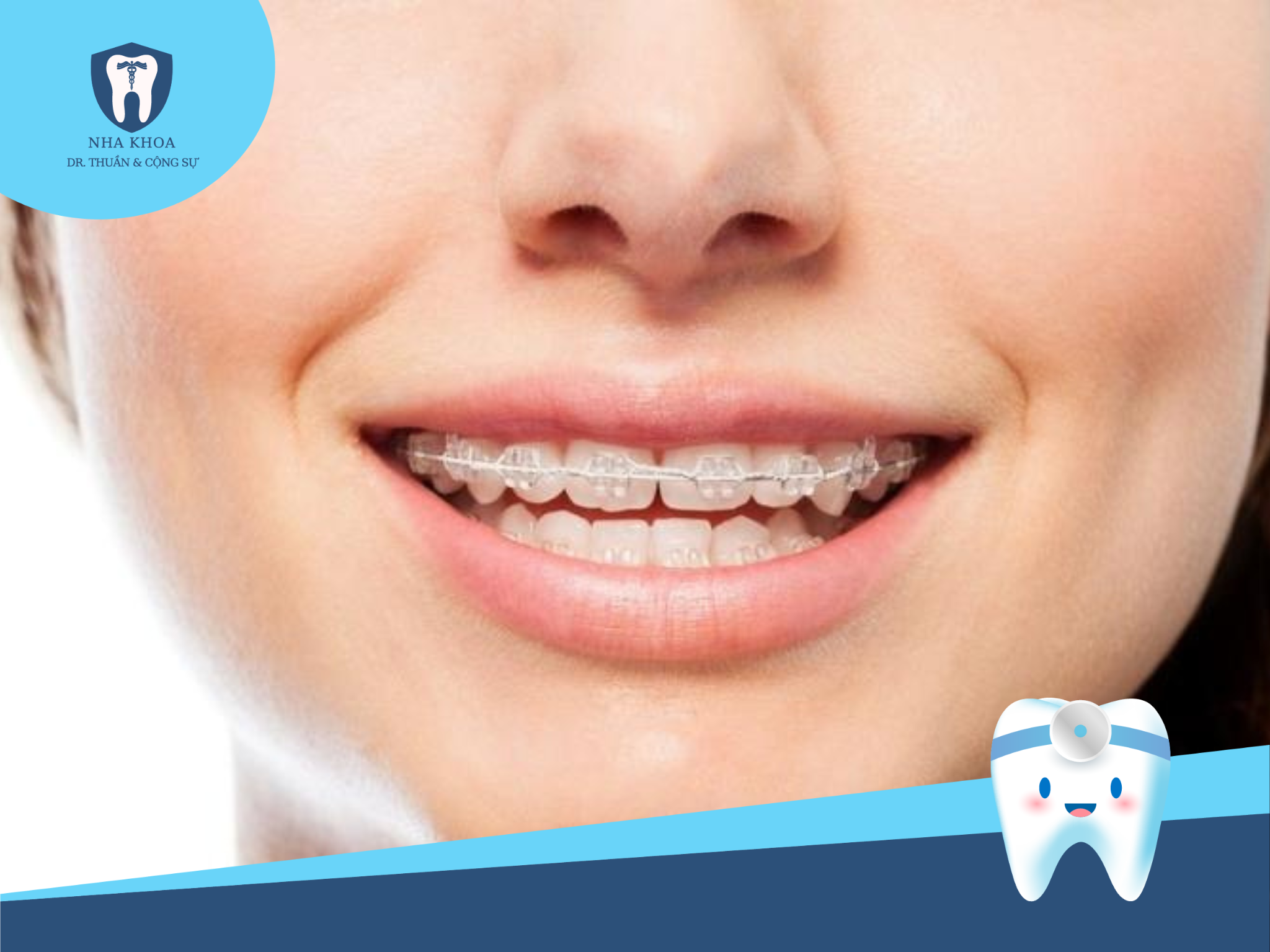 Niềng răng mắc cài sứ là một phương pháp điều trị chỉnh nha sử dụng mắc cài và dây cung để điều chỉnh vị trí của răng trên khuôn hàm.