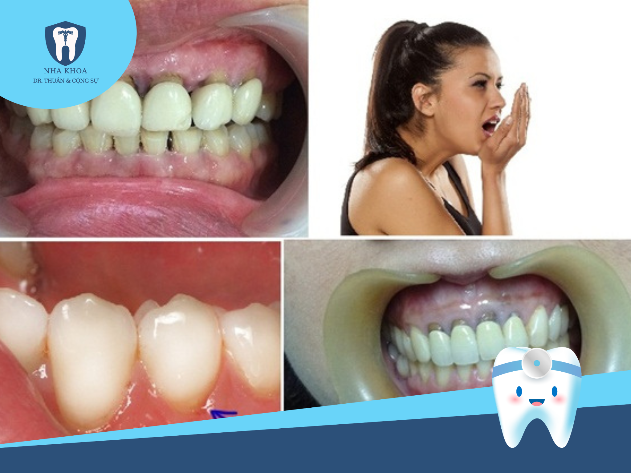 Khi thực hiện bọc răng sứ mà không đảm bảo về chất liệu và kỹ thuật, sau một thời gian dài, men răng dưới lớp vỏ sẽ bị bào mòn, gây ra tình trạng răng sứ lung lay và dễ rơi ra.