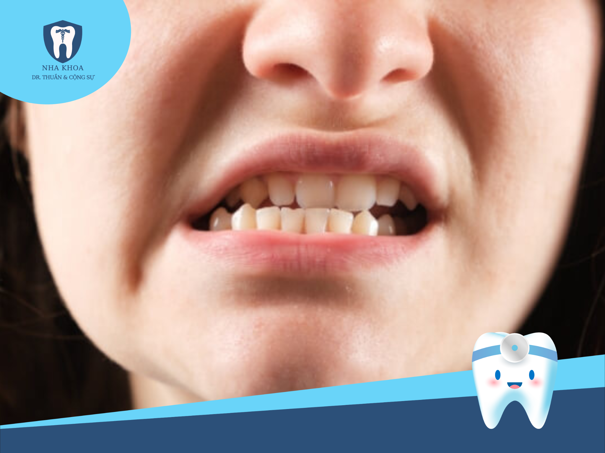 Trong trường hợp khớp cắn bị sai lệch nghiêm trọng, bạn có thể cần phải tiến hành niềng răng chỉnh nha trước để điều chỉnh khớp cắn về vị trí đúng, sau đó mới xem xét khả năng bọc răng sứ.