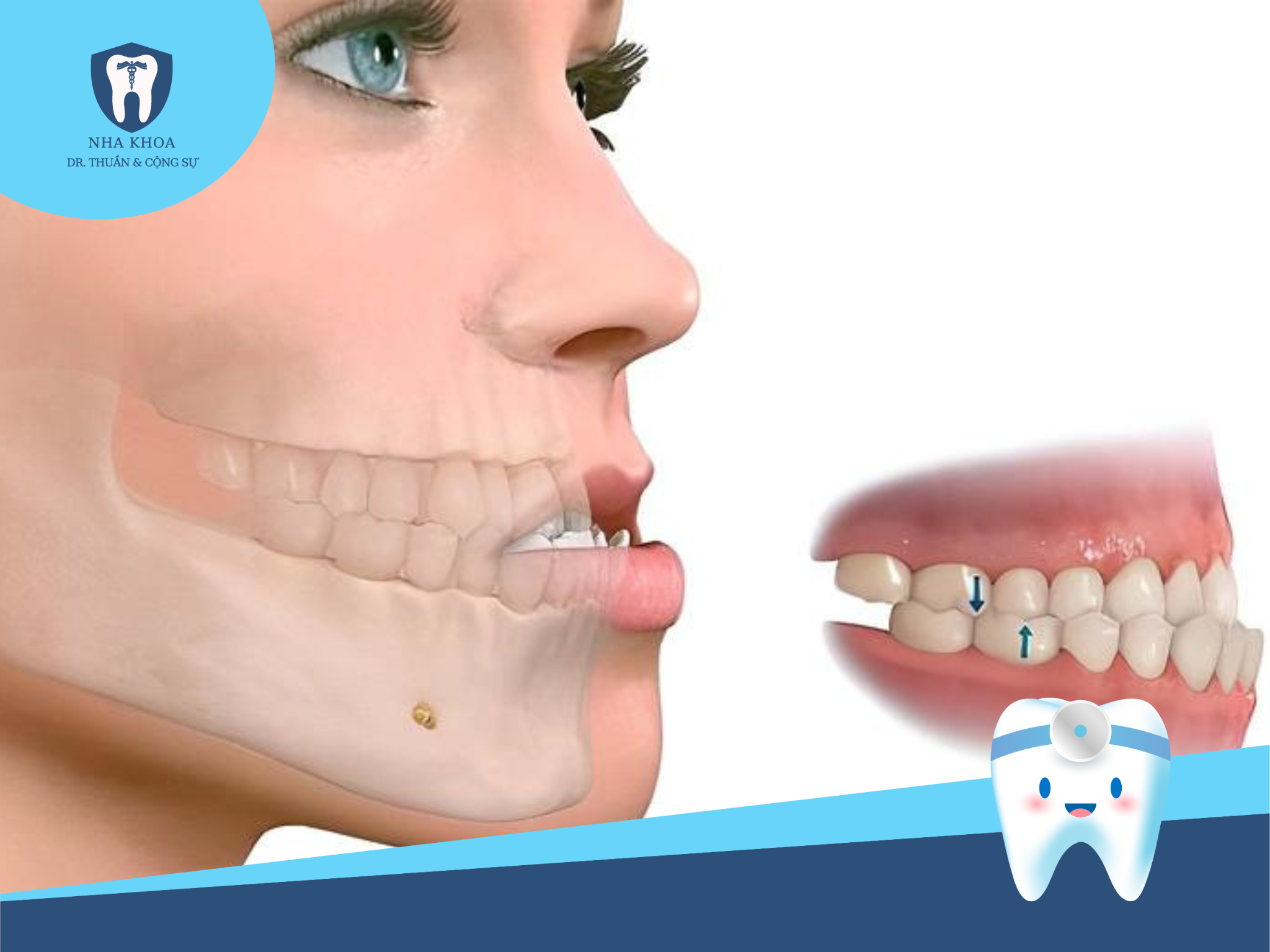 Trong trường hợp hàm răng bị hô, vẩu, hoặc móm do nguyên nhân là cấu trúc xương hàm, không nên lựa chọn phương pháp bọc răng sứ vì không thể điều chỉnh răng về đúng vị trí. 