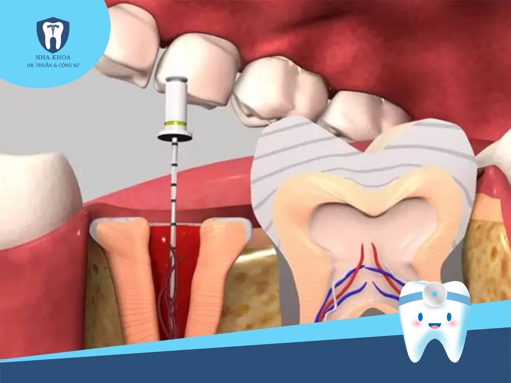Phương pháp bọc răng sứ giúp bảo vệ răng thật từ bên trong.