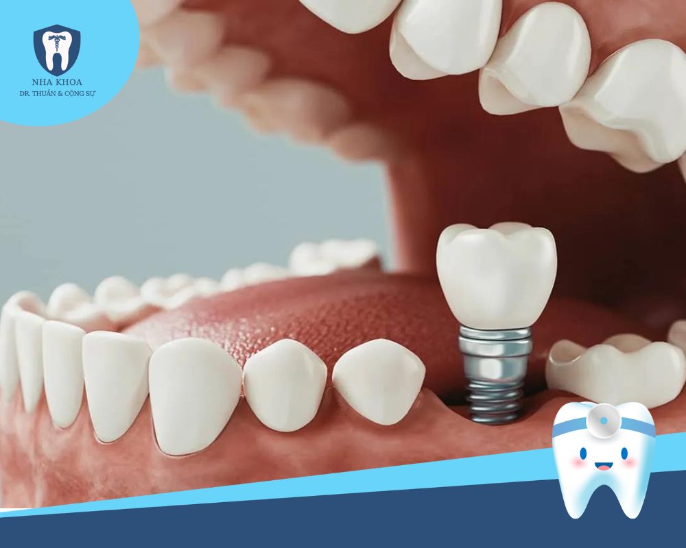 cấy ghép răng implant