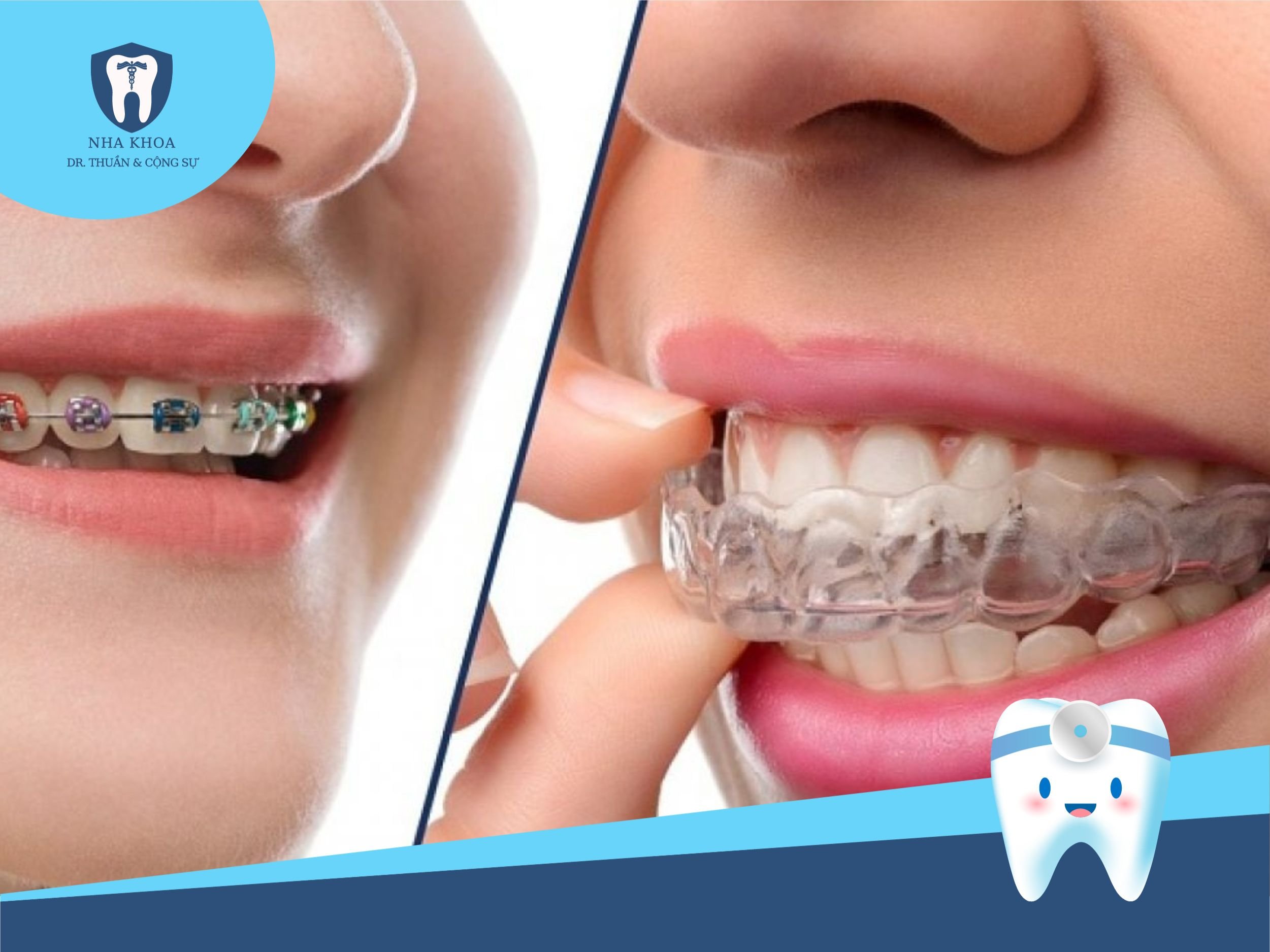 Khay niềng răng trong suốt là phương pháp chỉnh nha hiện đại, hiệu quả và thẩm mỹ cao