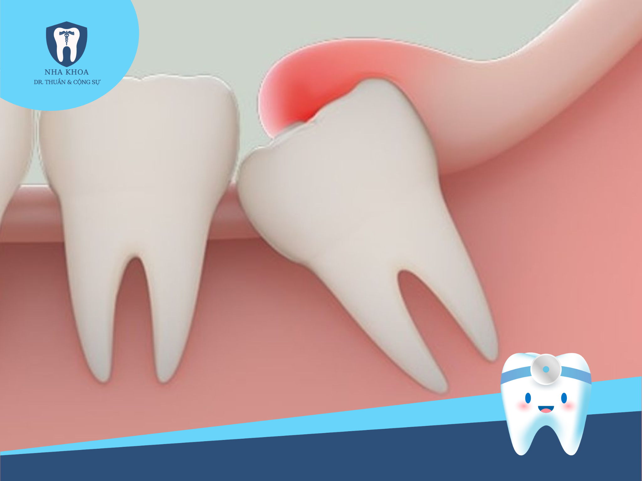 Phương pháp nhổ răng khôn ngày nay đã trở nên phổ biến hơn và ít gặp biến chứng nhờ vào sự tiến bộ của công nghệ máy móc.