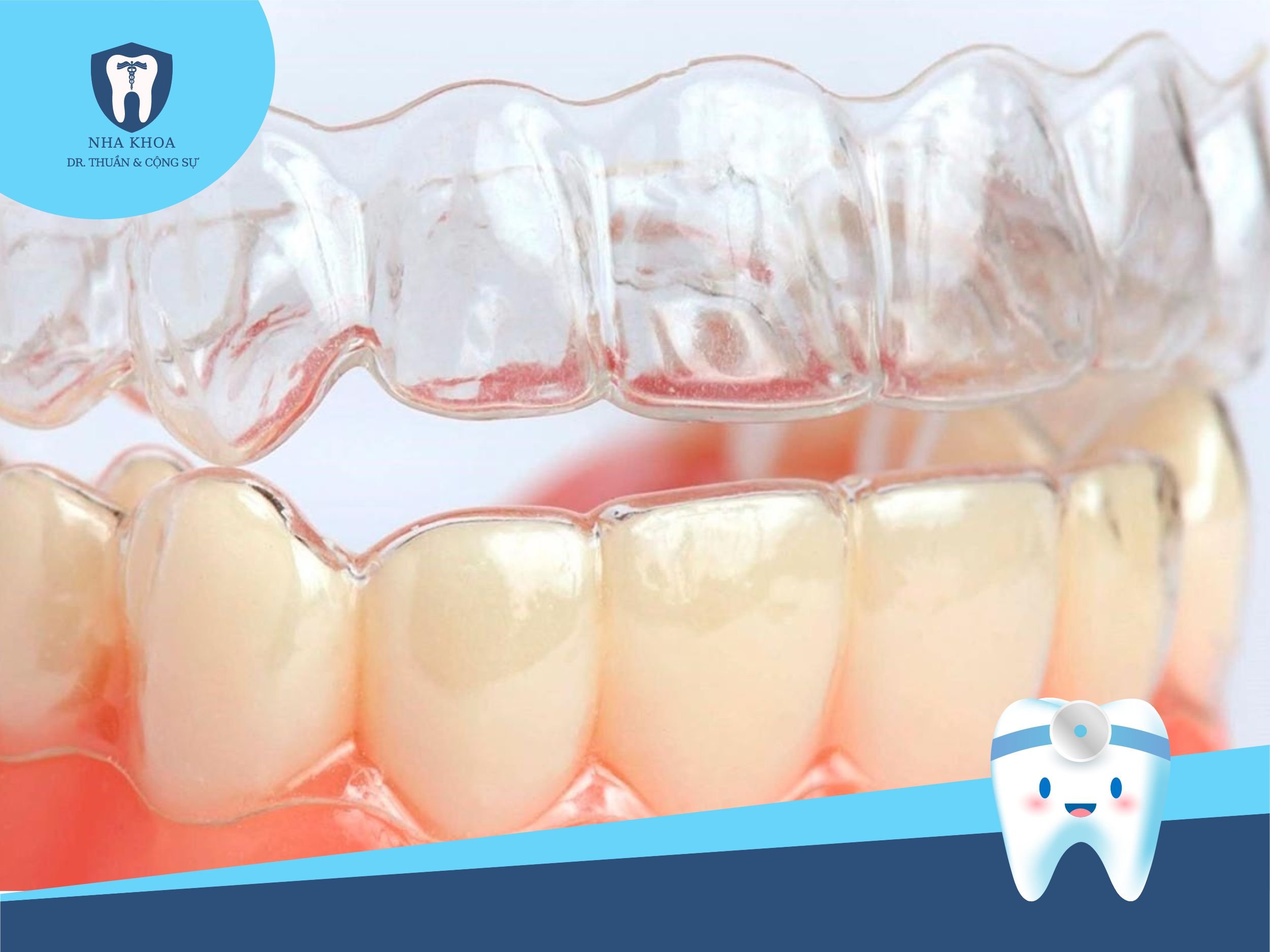 Nha khoa Dr Thuần là một trong những nha khoa uy tín tại Việt Nam cung cấp dịch vụ niềng răng Invisalign