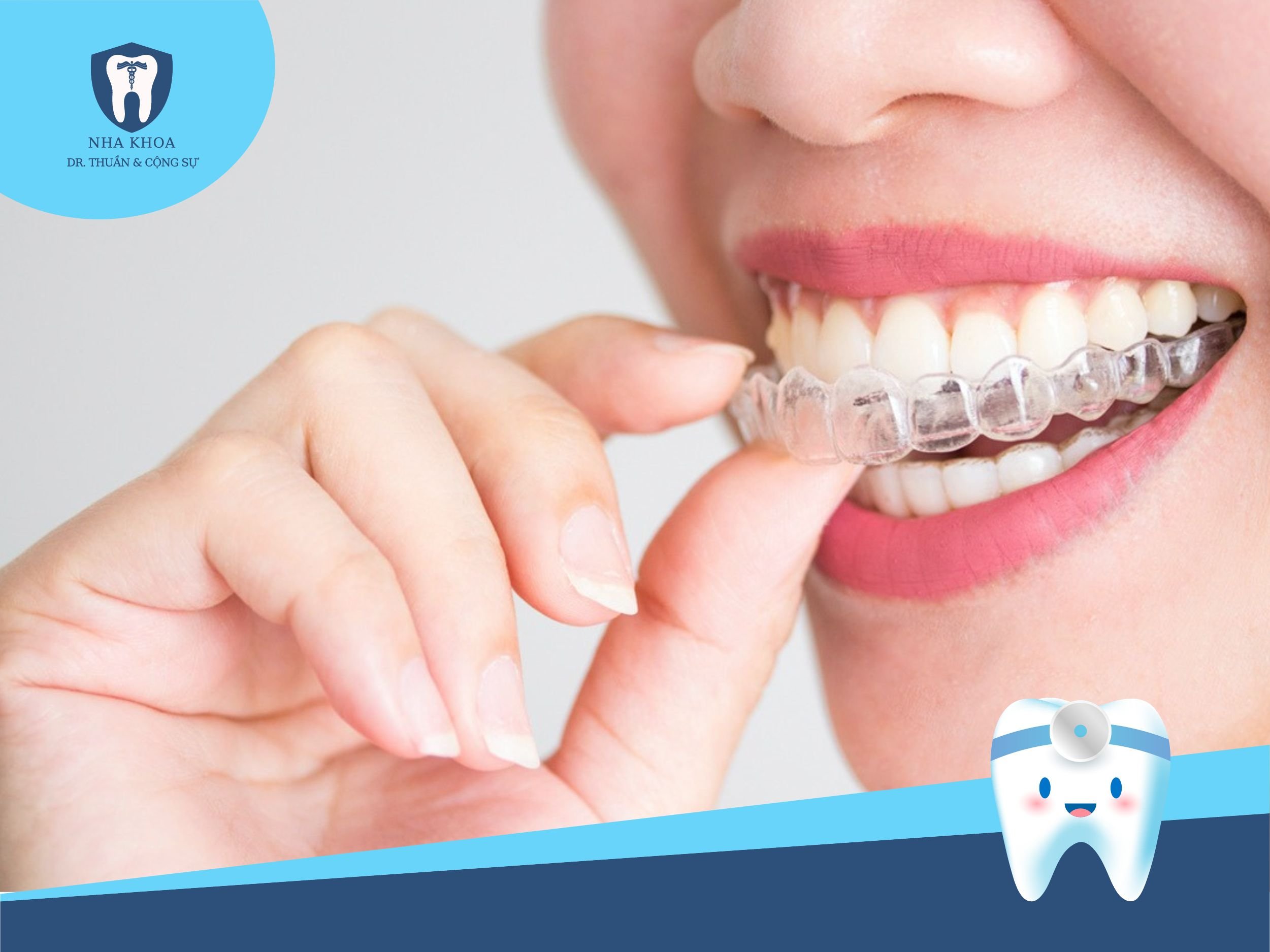 Quy trình niềng răng Invisalign