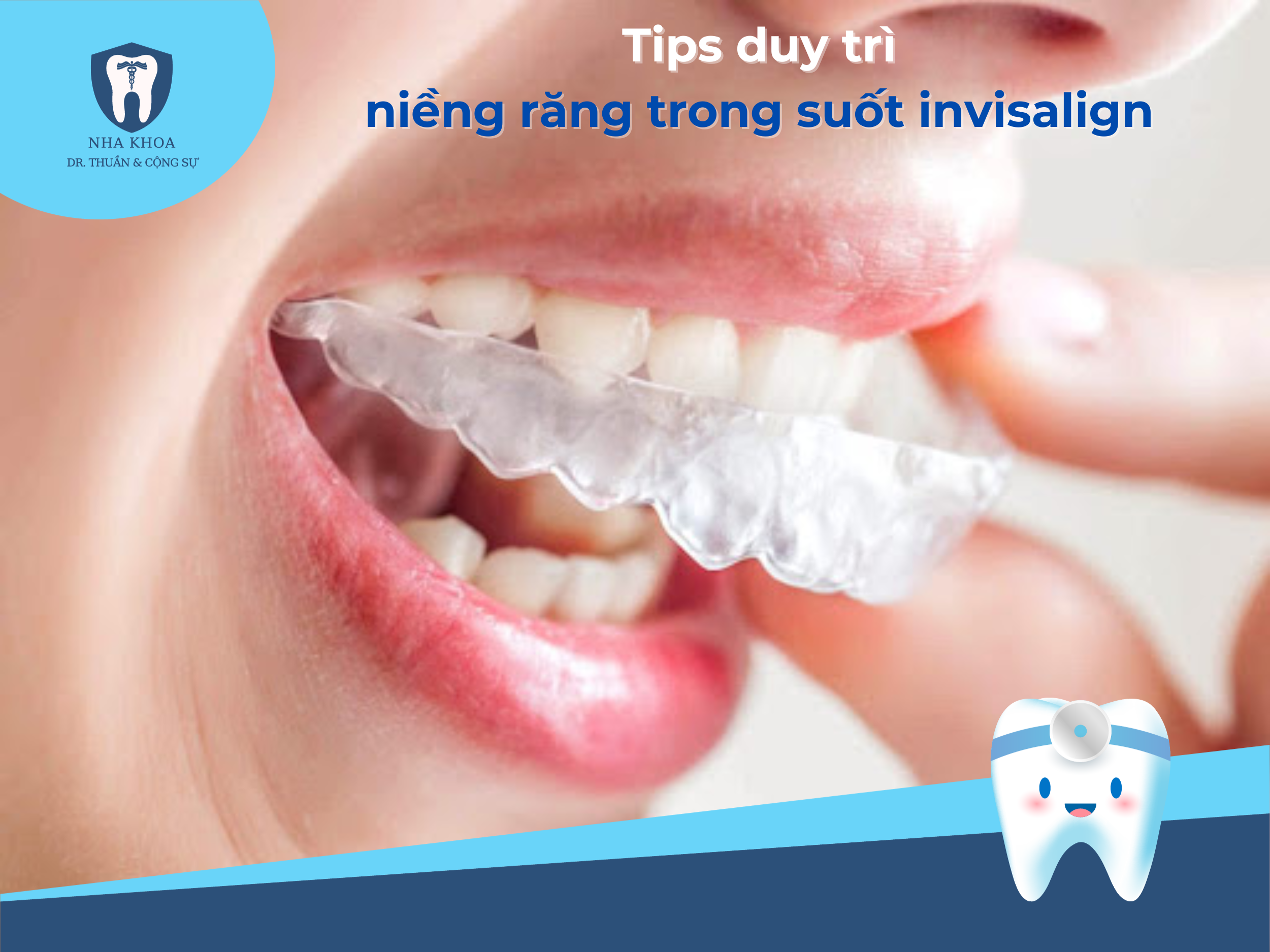 nieng-rang-trong-suot-invisalign-1-1